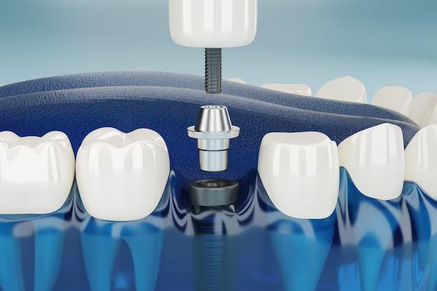 The Science of Best Dental Implants in Aberdeen: How They Work and Why They Last
