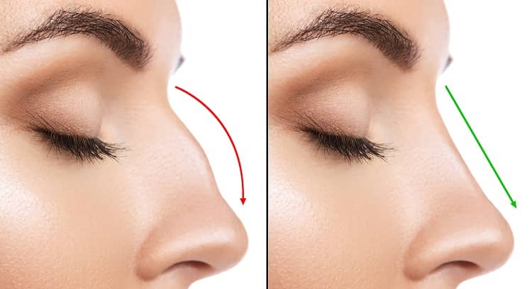 How Long Does A Typical Rhinoplasty Take To Perform?