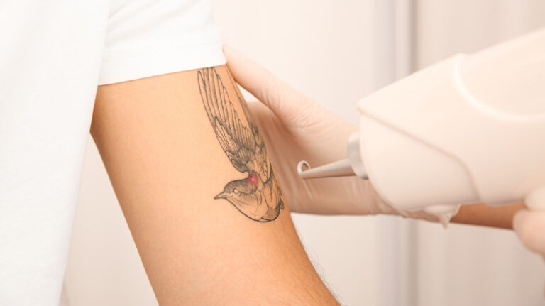 Uninked & Unbothered: Laser Tattoo Removal in Dubai 101?